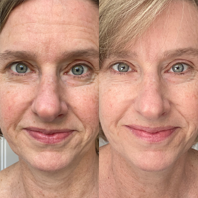 kim malmstrom collagen